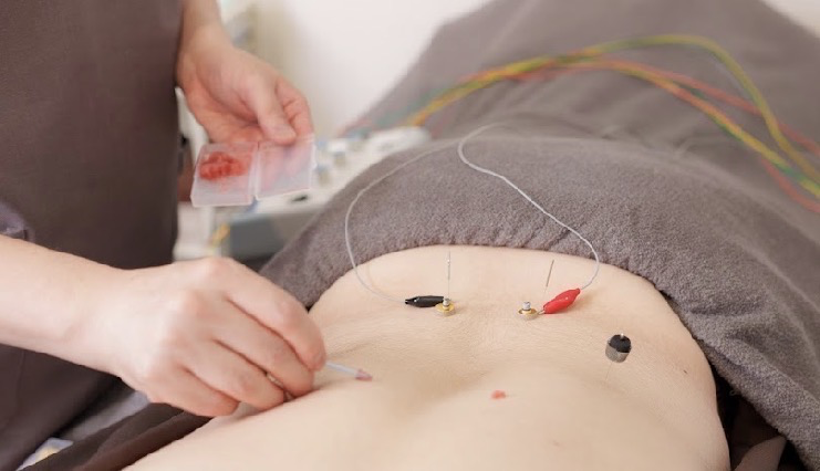 背中への鍼灸施術(電針と灸)の様子。